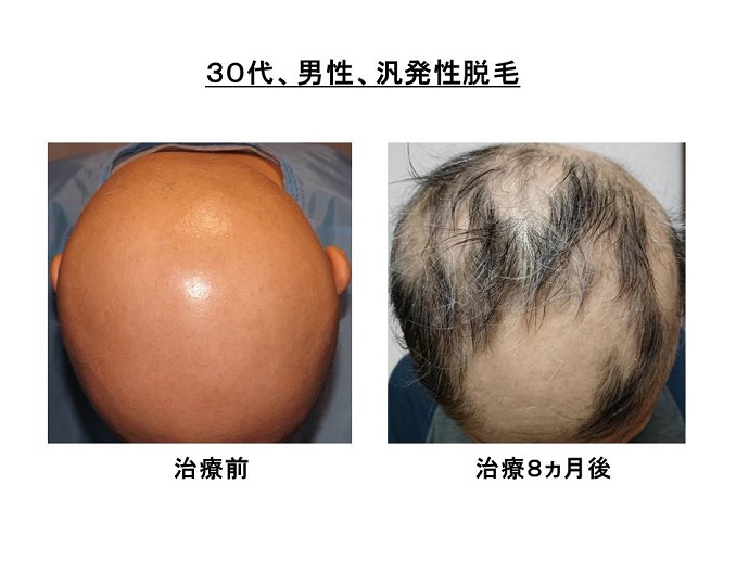 円形脱毛症　病院""
